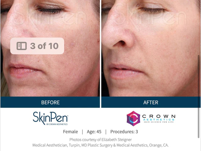 Collagen Induction Therapy (Microneedling) with SkinPen - Full Face and Neck